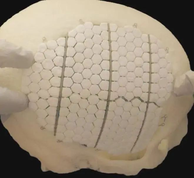 PEEK - Material avançado para cranioplastia