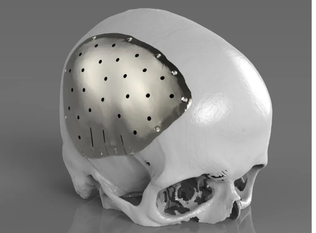 PEEK - Material avançado para cranioplastia