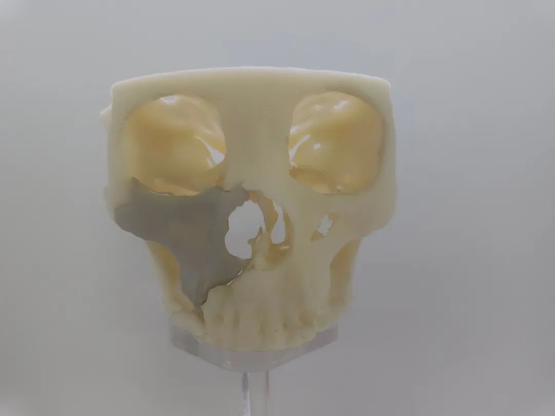 PEEK - Material avançado para cranioplastia