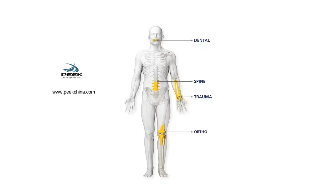 Aplicação do Material PEEK na Indústria de Dispositivos Médicos