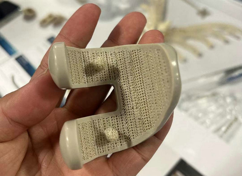 Implantes PEEK de Grau Médico Impressos em 3D