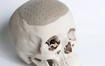 PEEK - Material avançado para cranioplastia