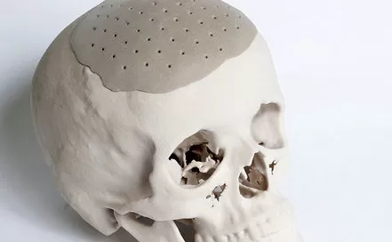 PEEK - Material avançado para cranioplastia