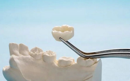 PEEK em Implantes Dentários: Biocompatibilidade e Benefícios Estéticos